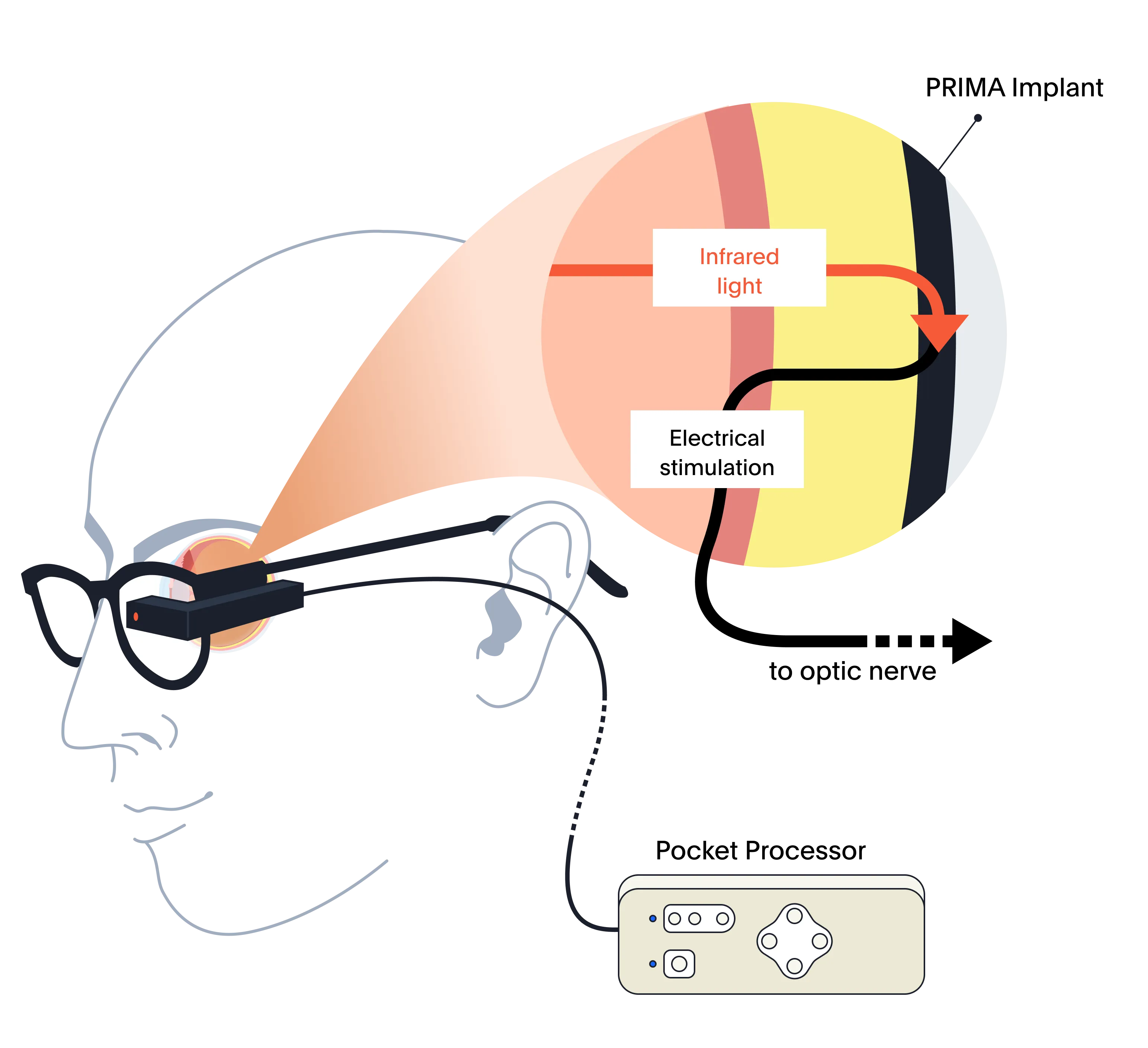The PRIMA mechanism of action: the PRIMA glasses are worn on the head normally and connected to the pocket processor. A detail view of the retina shows the PRIMA implant replacing the function of the photoreceptor layer.