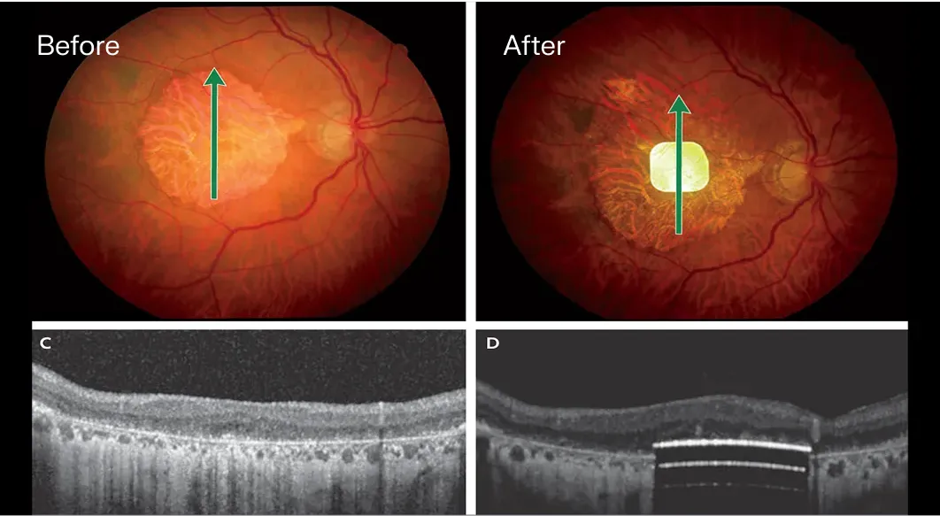 Fundus and optical coherence tomography (OCT) images of a PRIMA patient before and after implantation showing the implant resting in the middle of the scotoma